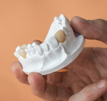 Anterior Crowns: A Helpful Guide for Dentists and Patients 