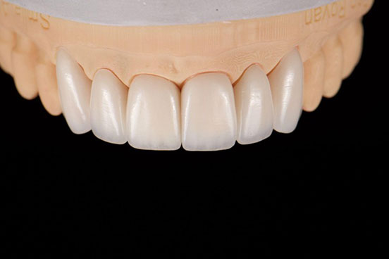 Choosing Between Zirconia and Lithium Disilicate