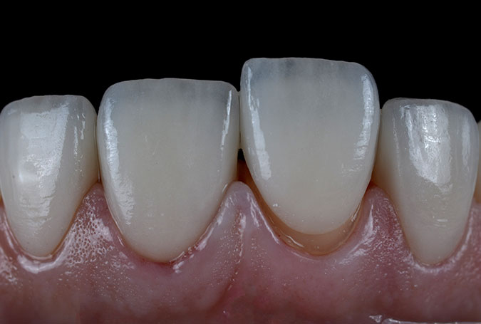 What to Expect During Porcelain Veneer Preparation