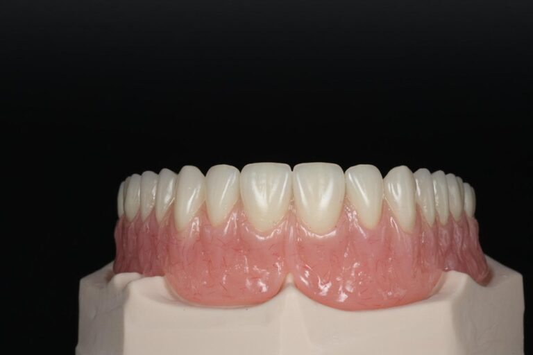 Removable Partial Dentures
