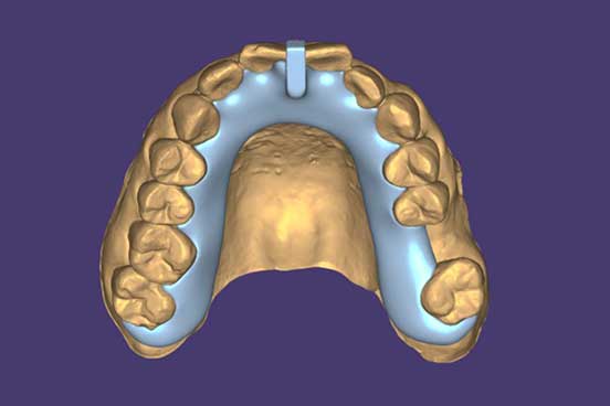 The Power of the Kois Deprogrammer in Modern Dentistry