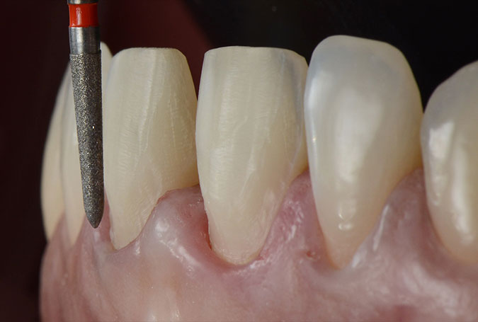What to Expect During Porcelain Veneer Preparation