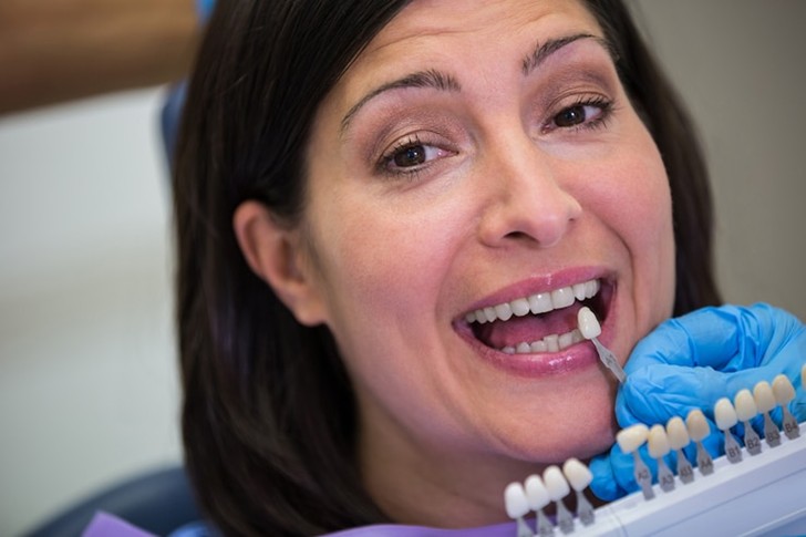 What to Expect During Porcelain Veneer Preparation