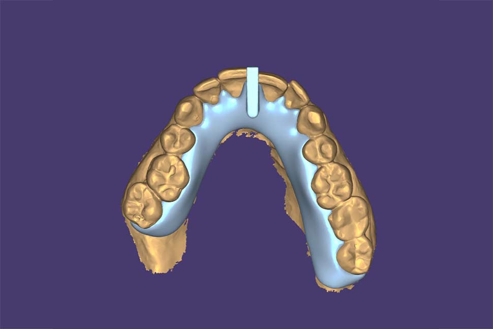 How Long Should You Wear a KOIS Deprogrammer?