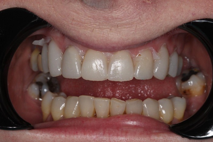 The Importance of Mock-Ups in Digital Smile Design Workflow