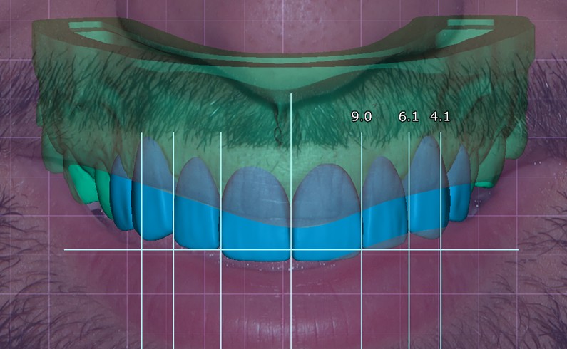 Digital Smile Design