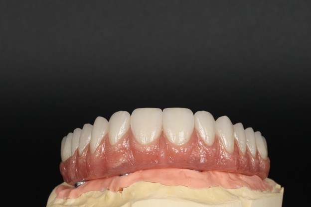 How to Choose the Right All-on-X Prosthetic Material and Framework