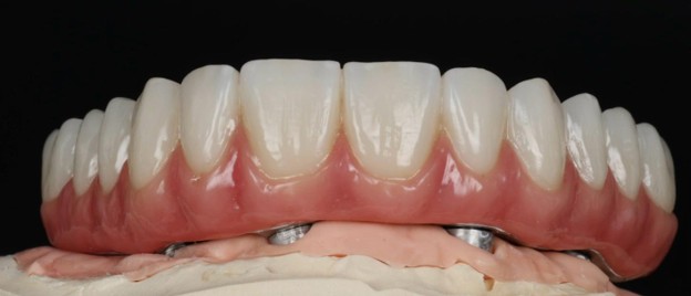 What Is All-on-X? A Complete Guide for Dentists