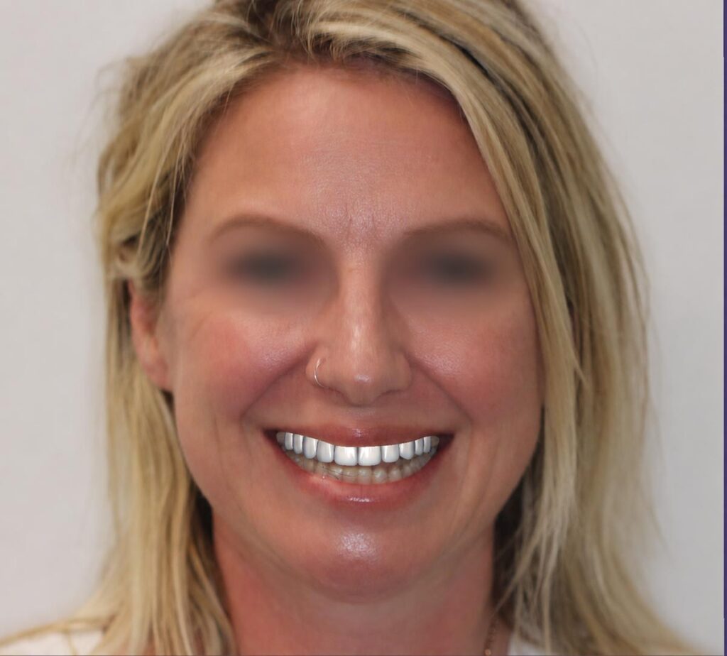 How Digital Smile Design Takes a Case From Records to Restoration