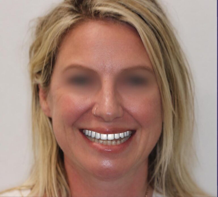 How Digital Smile Design Takes a Case From Records to Restoration