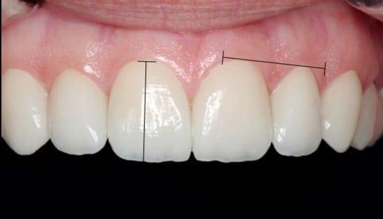 How Gum Architecture Influences Smile Design